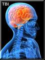 traumatic brain injury attorney